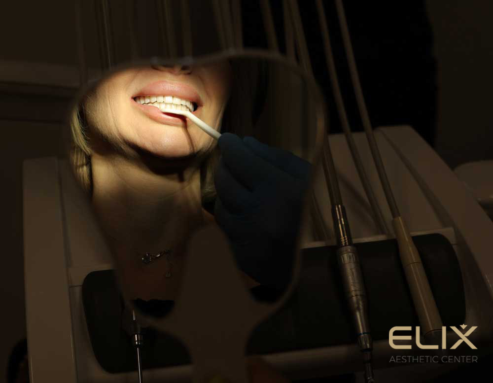 Installation of veneers in Yerevan